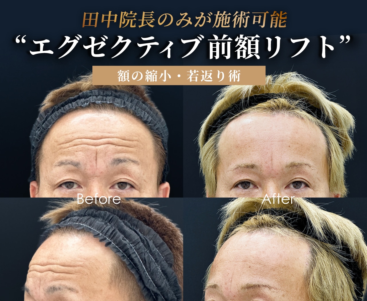 エグゼクティブ前額リフト・こめかみリフト