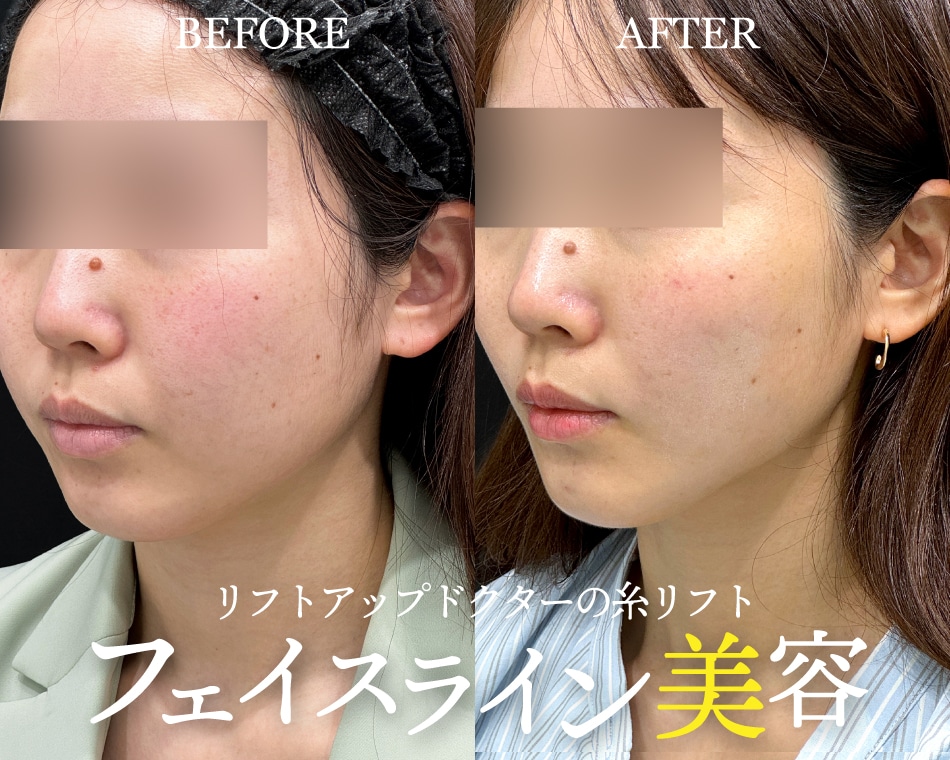 大阪・関西で糸リフトならリフトアップ名医・形成外科専門医 田中永紅へ | たるみ改善・小顔