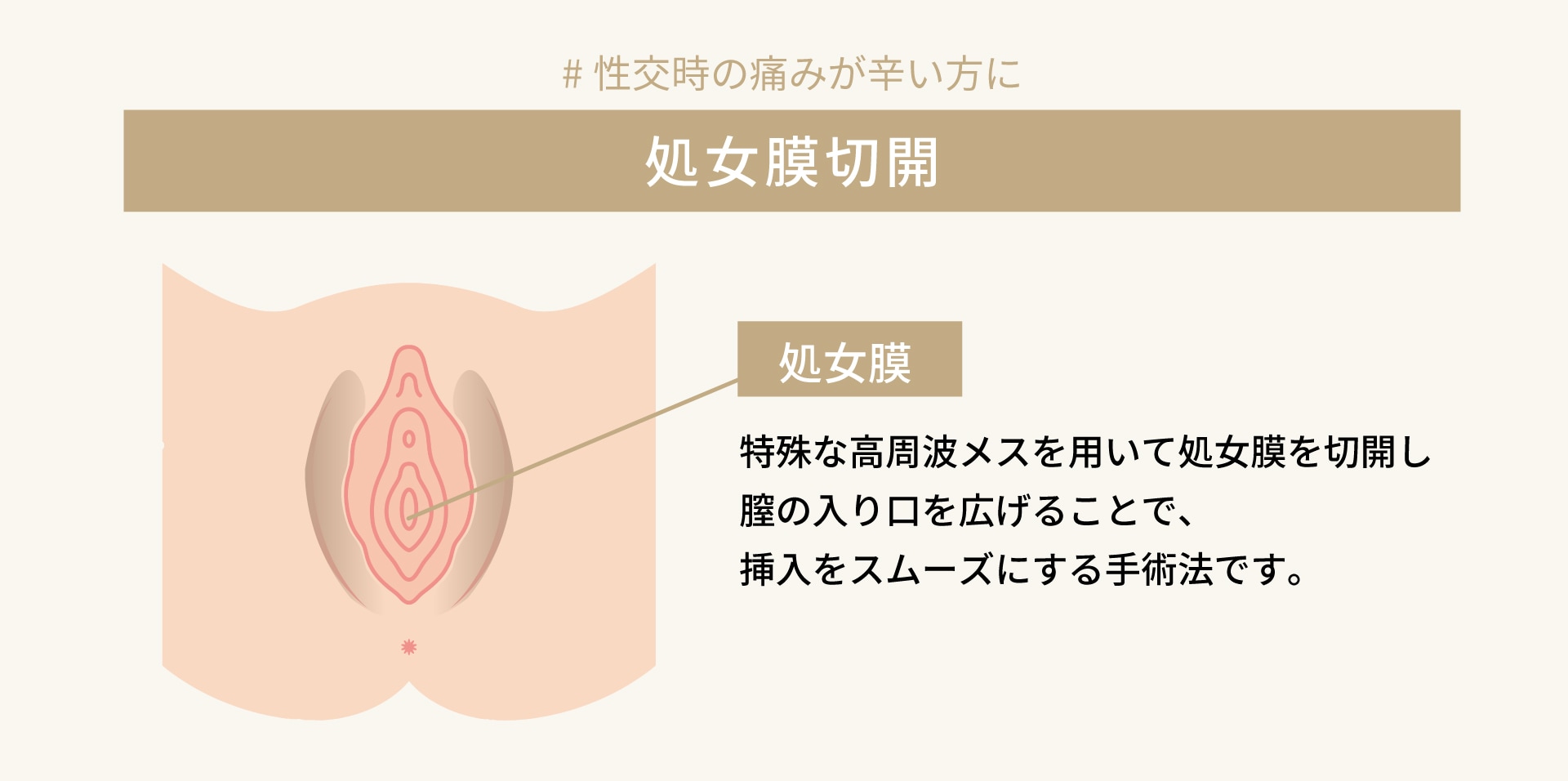 膣ボトックス × 処女膜切開