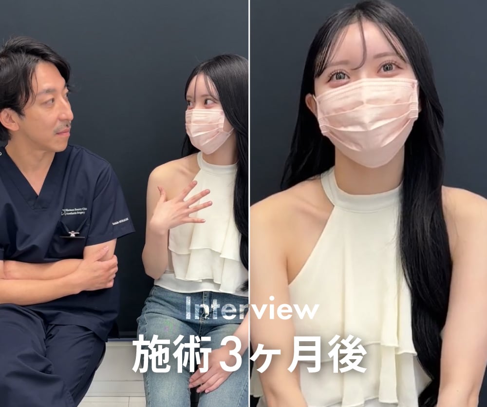埋没法二重術のダウンタイムは？