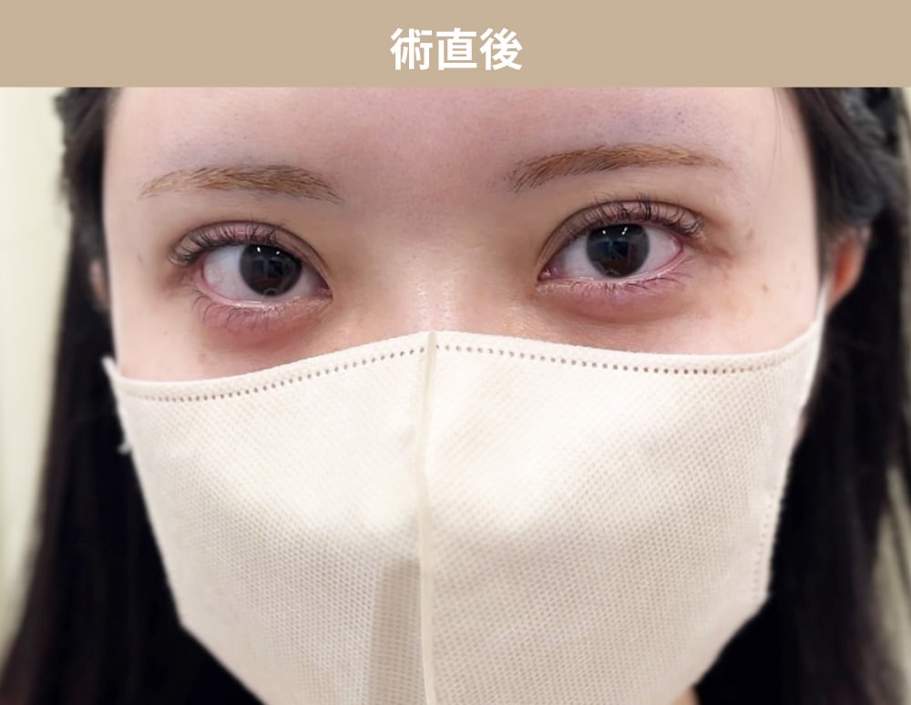 埋没直後から1週間目までの毎日レポ