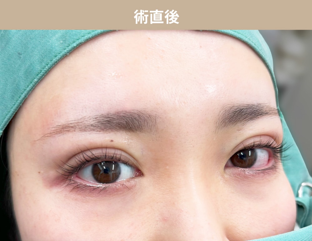 埋没二重直後から1ヵ月目までの自撮りレポ