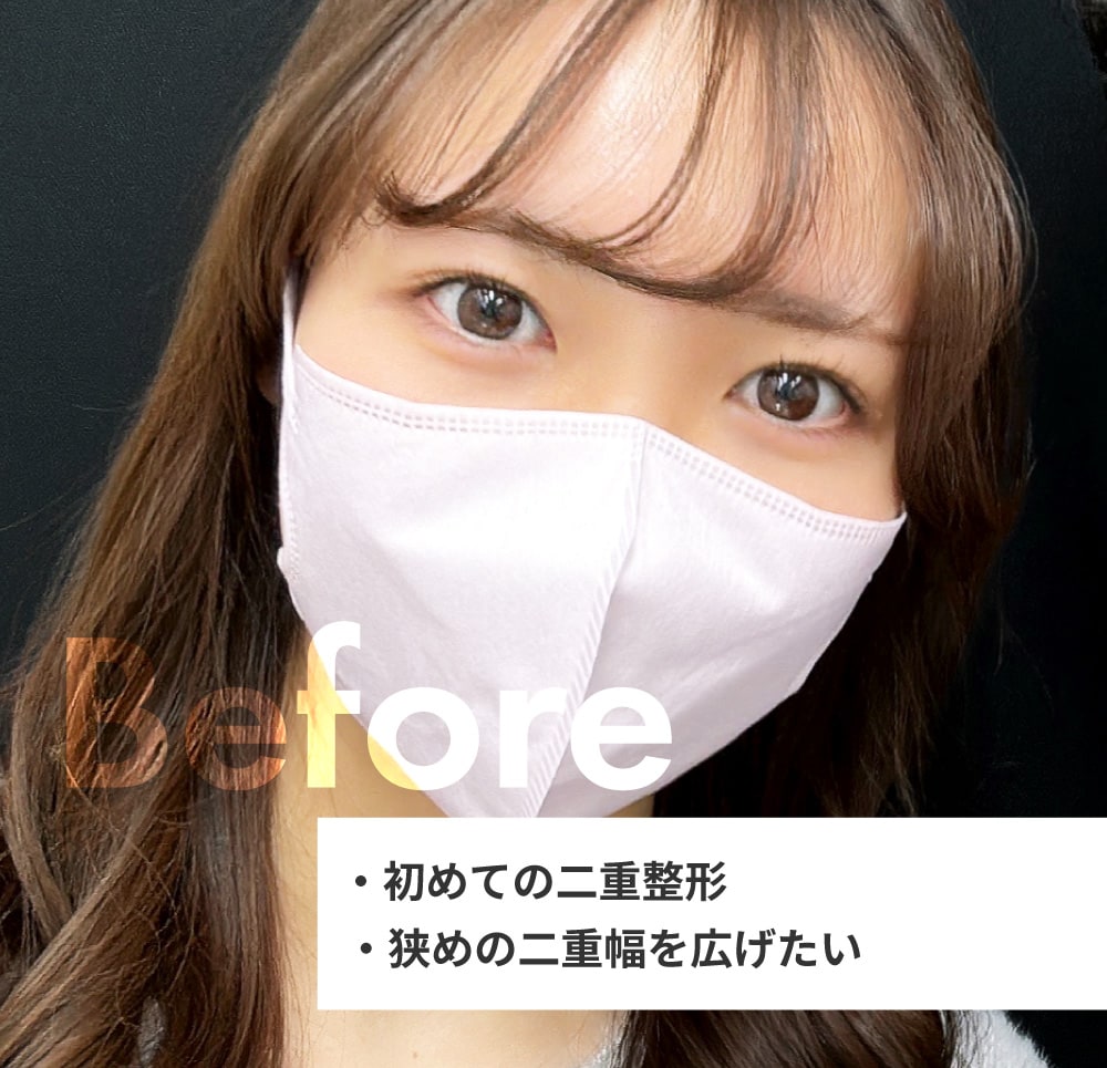 受けた埋没法二重術は【 クイックコスメティーク・トリプルNEO 】