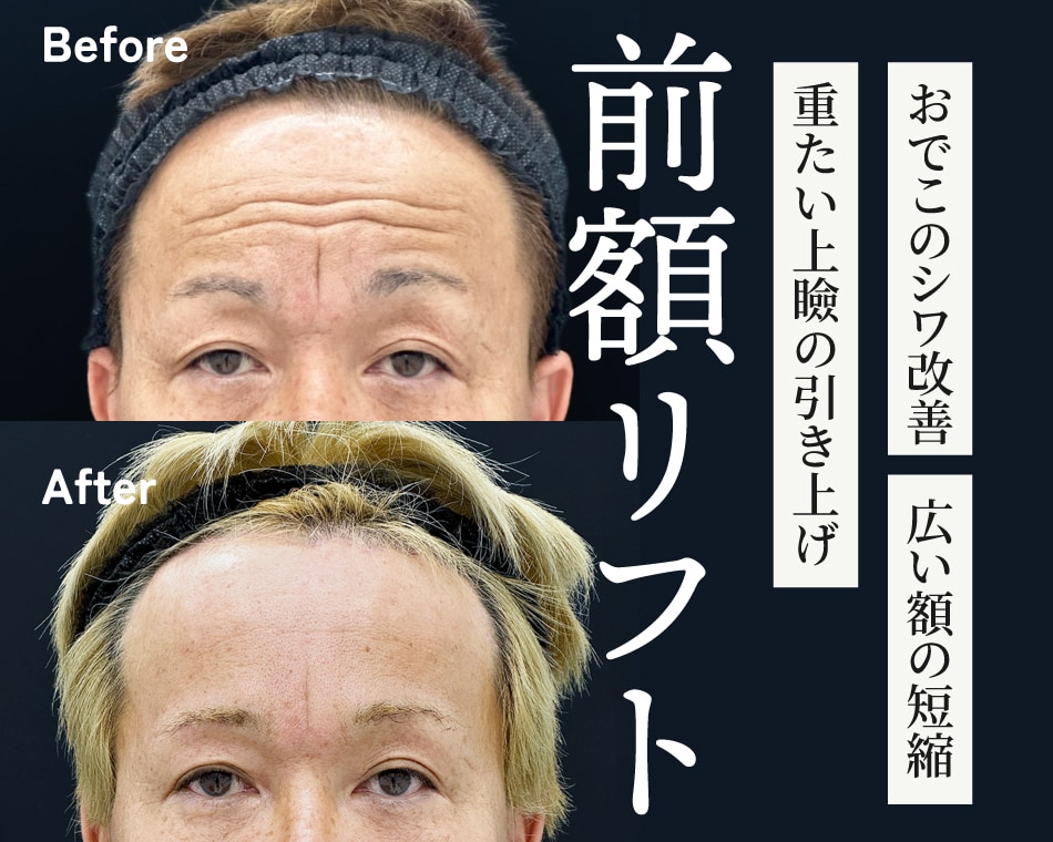 おでこのシワ改善｜深いシワにも効果的な方法を徹底解説【 大阪でおすすめシワ改善 】