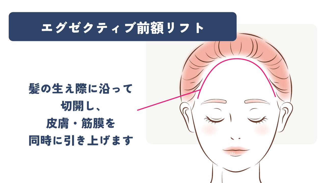 手術方法は？