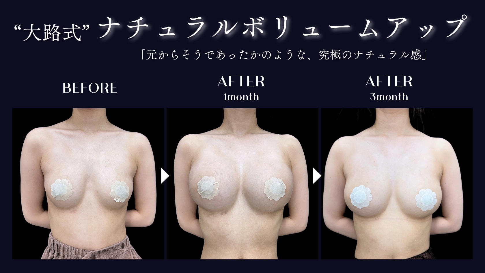 バストの構造を知り尽くす大路医師だから叶う、理想のナチュラルデザイン✨