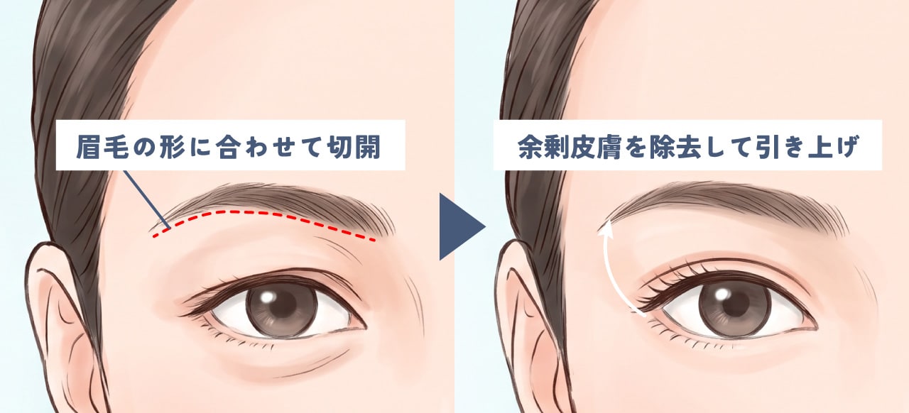 眉毛の下を切開し瞼のたるみを引き上げる