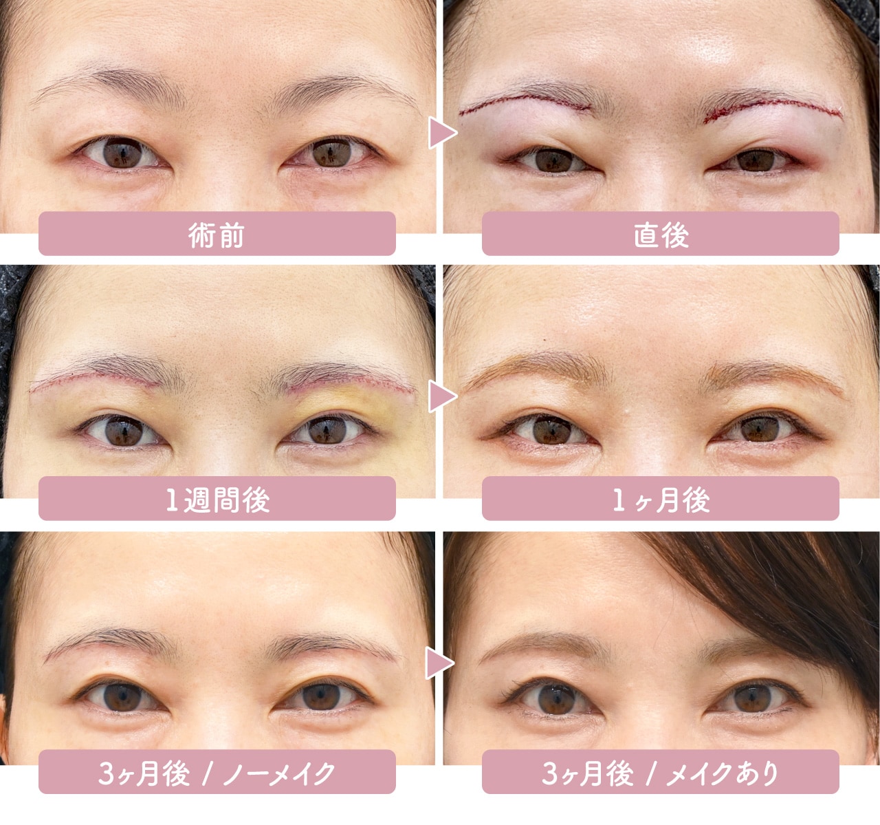 眉下切開のダウンタイムは？