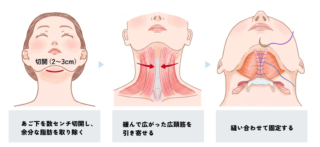 ペリカン手術の方法