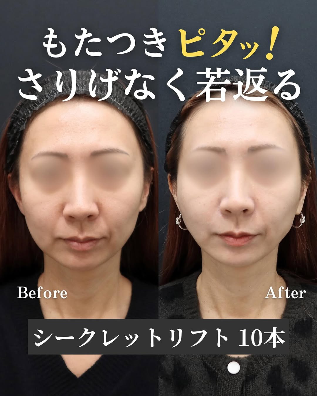 1月のおすすめNo. 1施術『糸リフト』