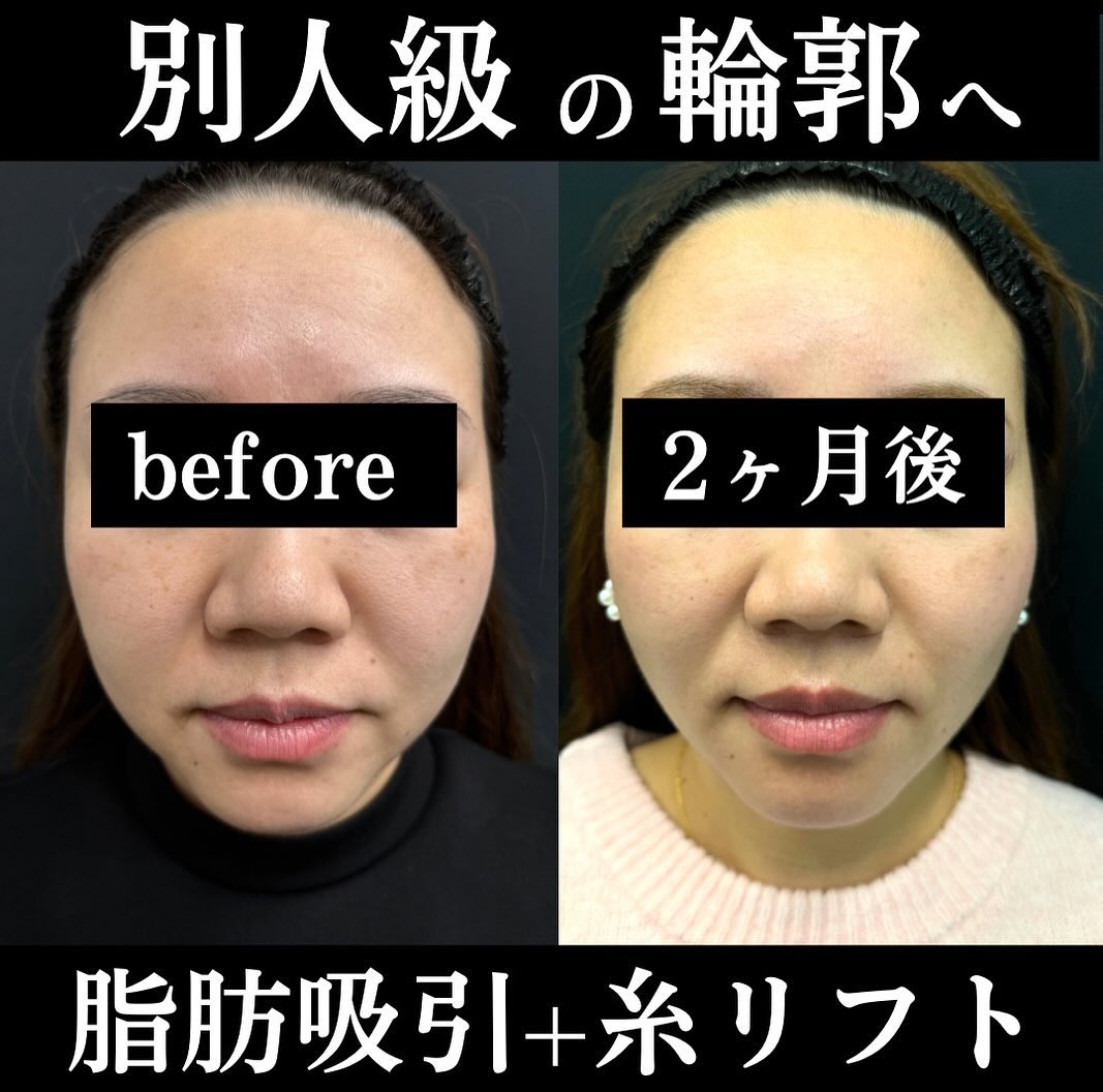 1月のおすすめNo.２施術『脂肪吸引注射』