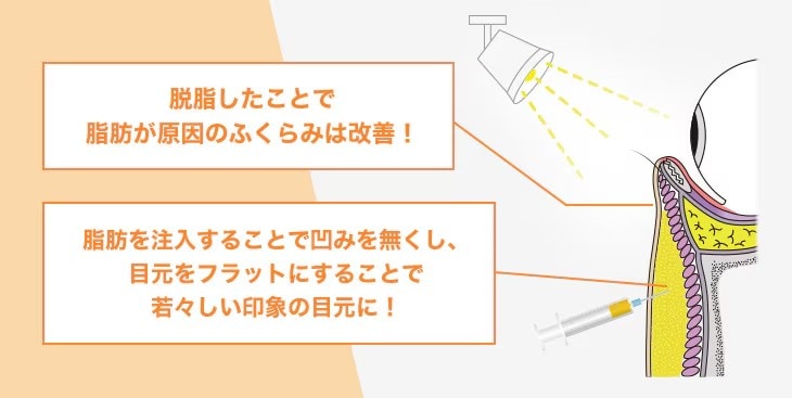 クマ取りには脂肪注入の併用がオススメです❣️
