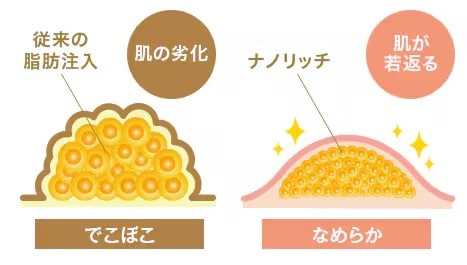 ナチュラル脂肪注入ナノリッチ