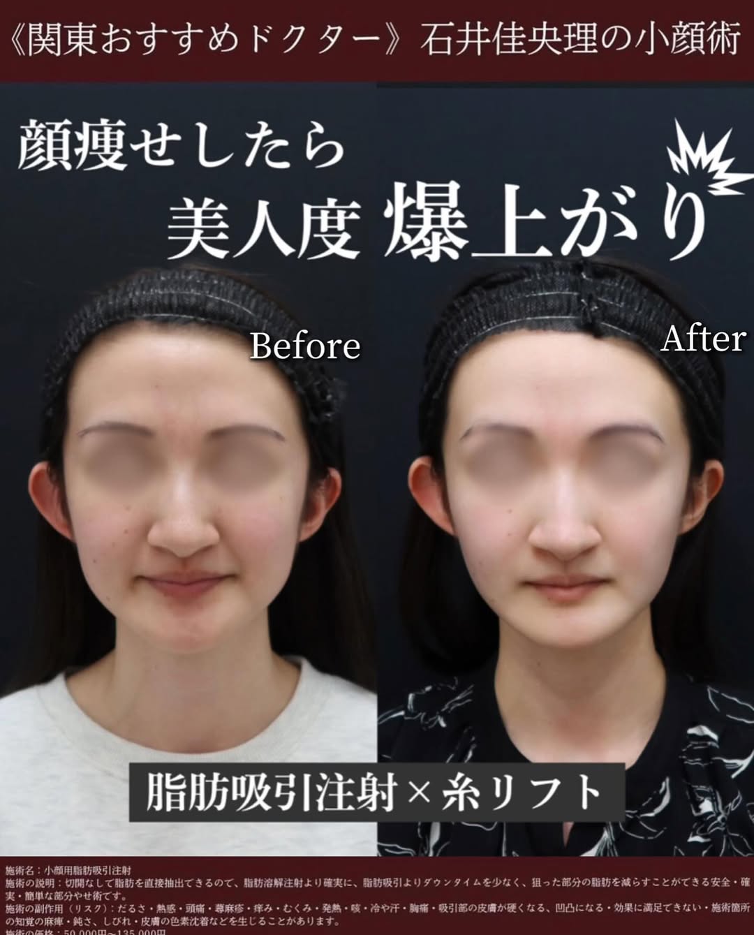 脂肪吸引でお顔の余白を減らす！