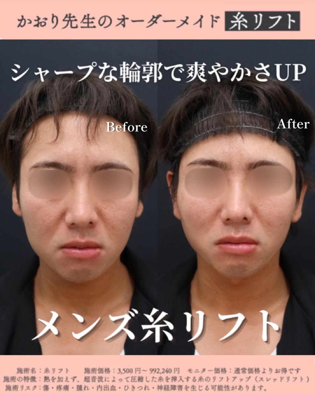 糸リフトで引き締まった輪郭に！