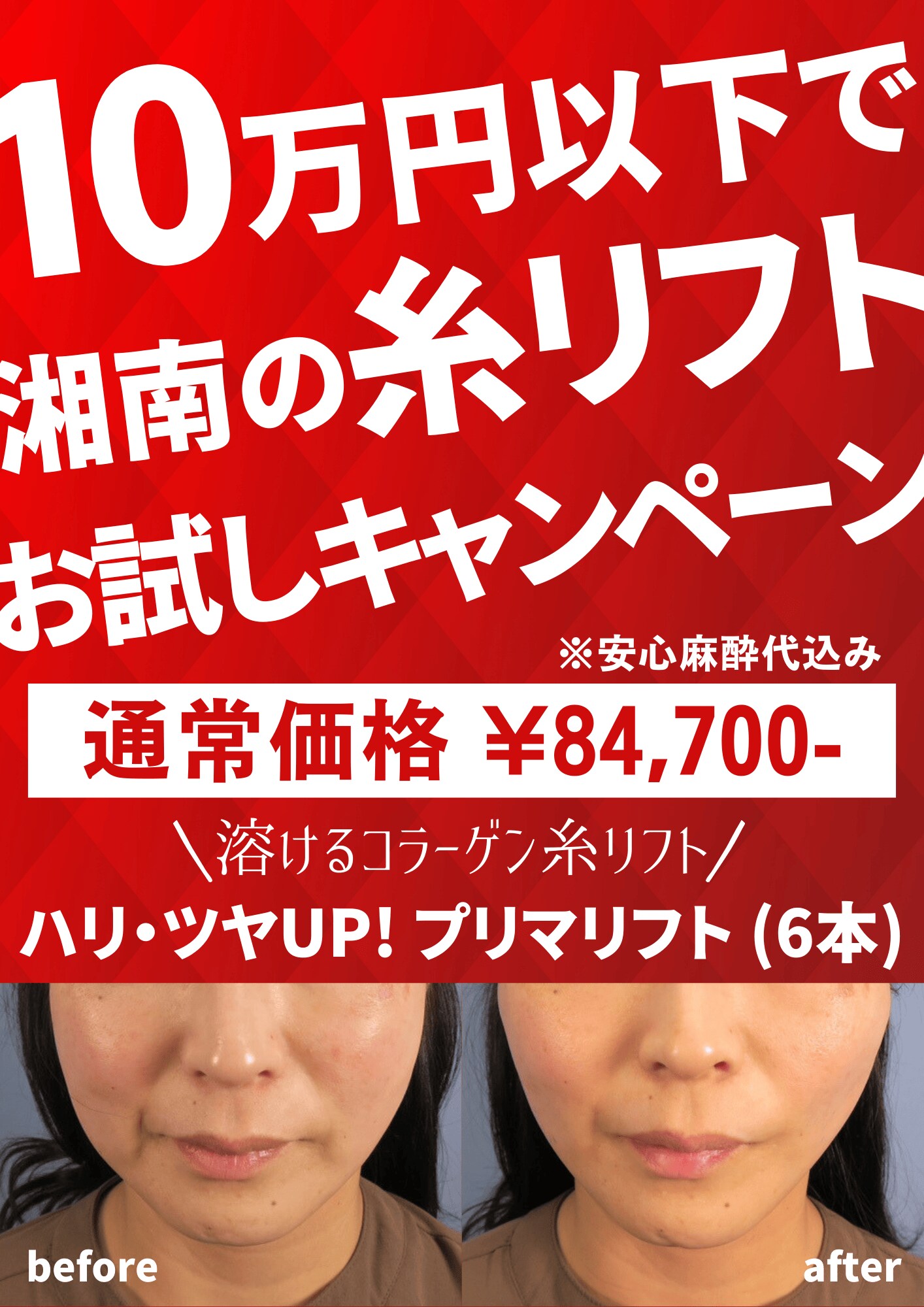 糸リフト初心者にもオススメ😊