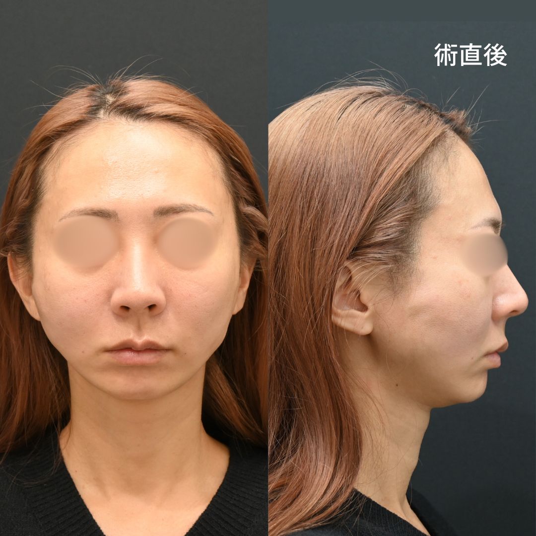 術直後