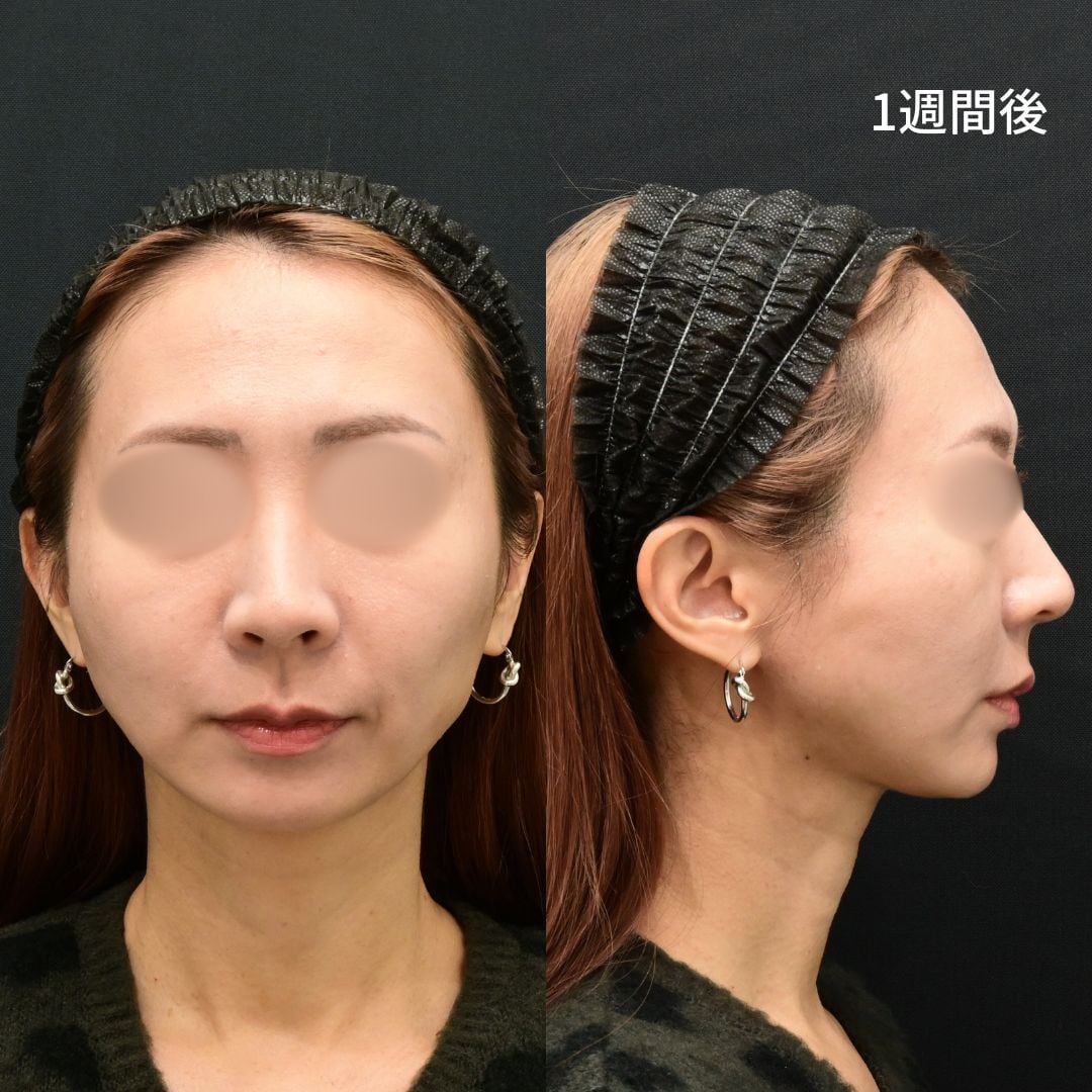 術後1週間