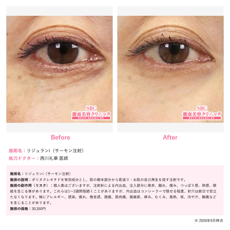 リジュラン単体