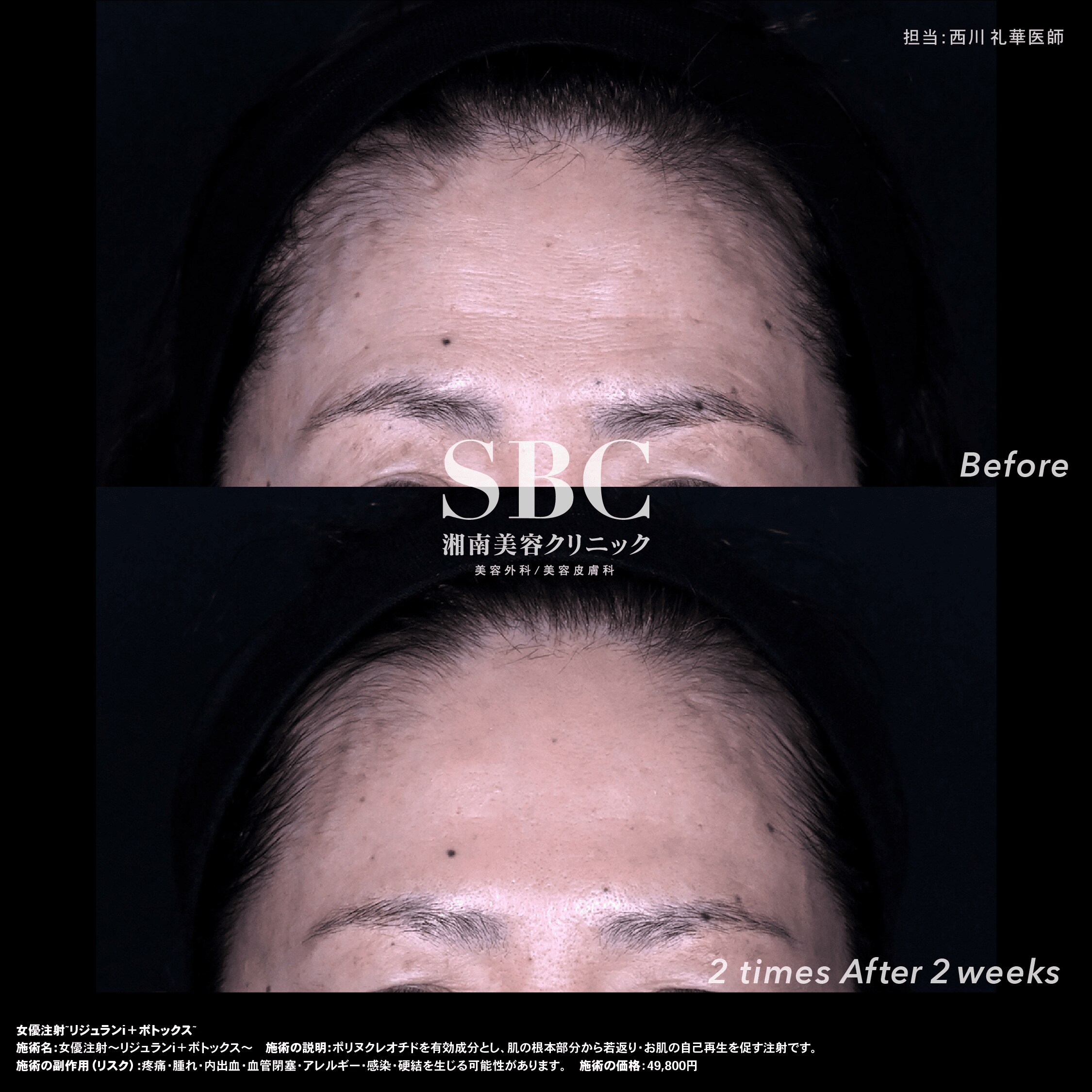 女優注射(リジュラン＋ボトックス)
