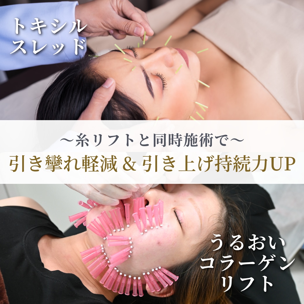 糸リフトと同時施術でショートスレッド20%OFF