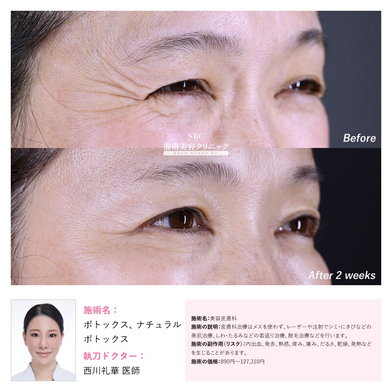 ボトックス注射