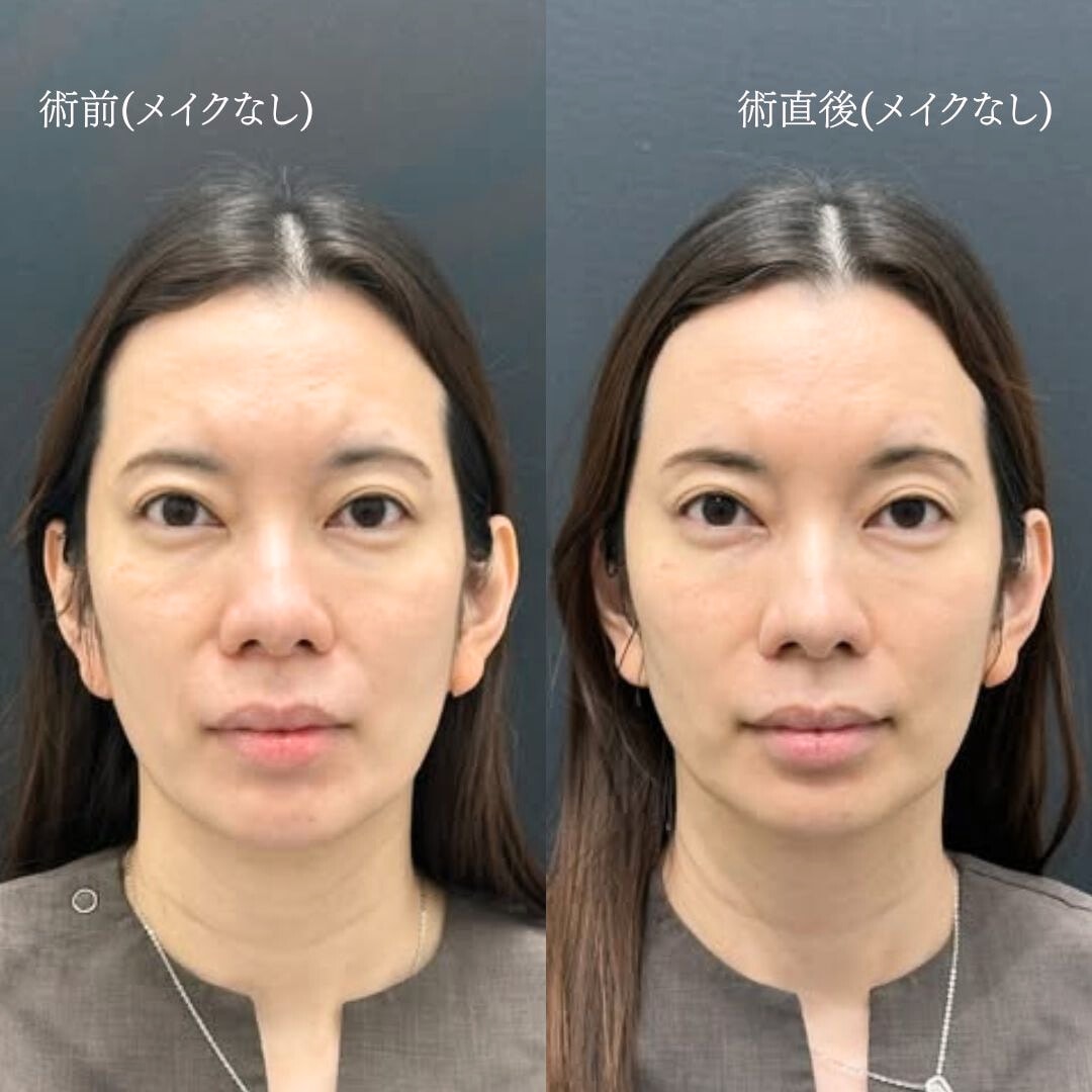 施術直後:ダウンタイムはどれくらい?