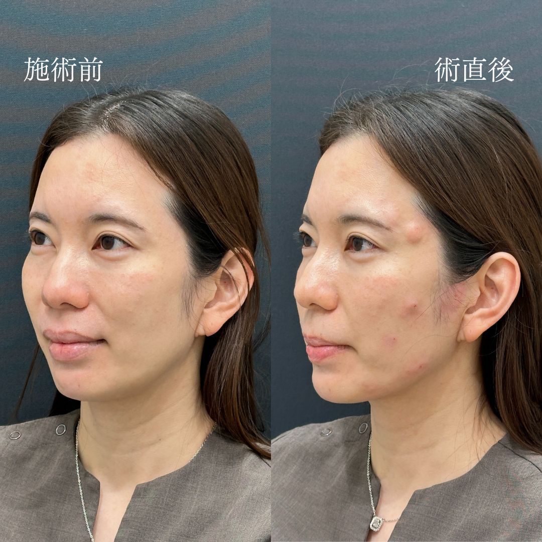 施術直後