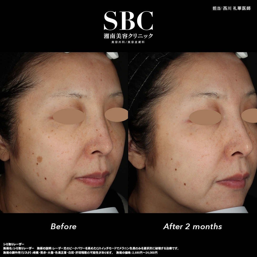 シミをピンポイントで狙い撃ち！