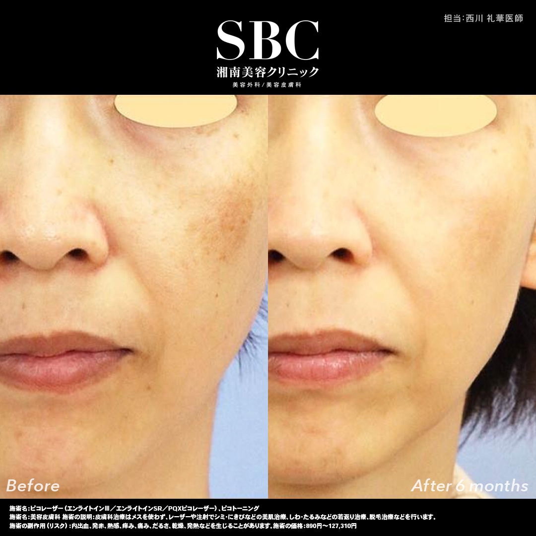 治りにくい肝斑にもアプローチ可能！