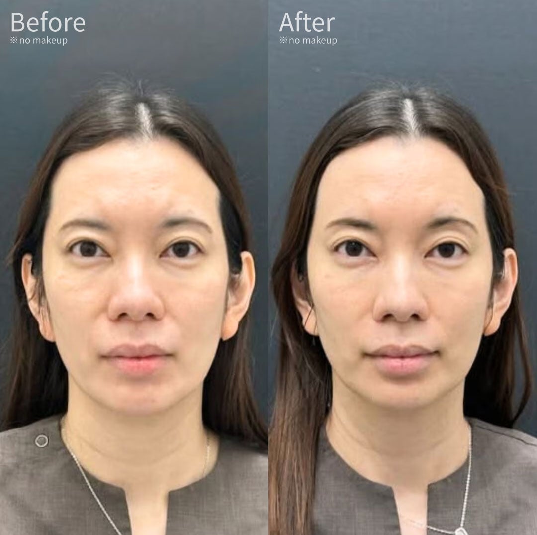 Immediately after the procedure: How long is the downtime?
