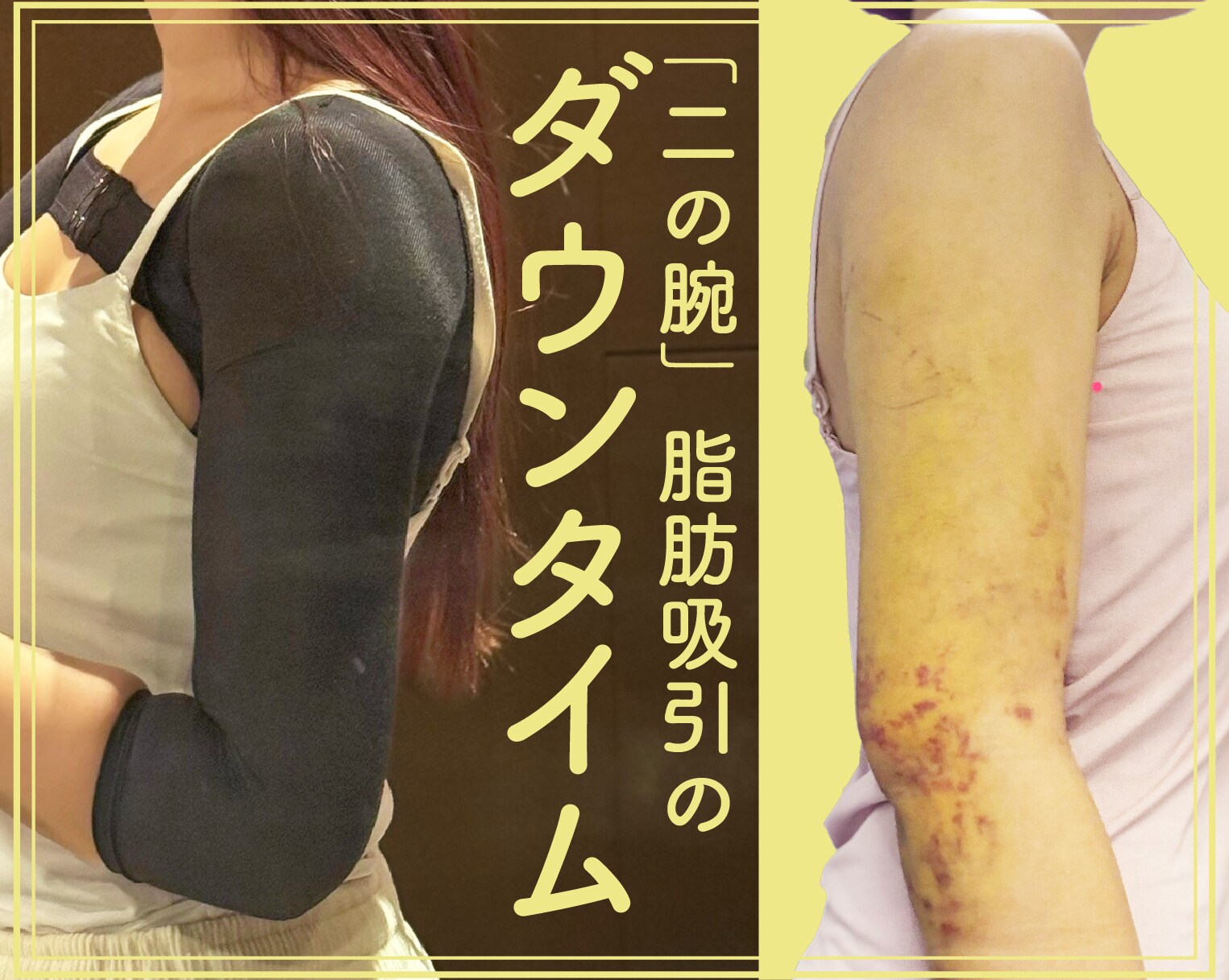 アミュレット 湘南美容外科 着圧ガードル （アミュレット 湘南美容外科  