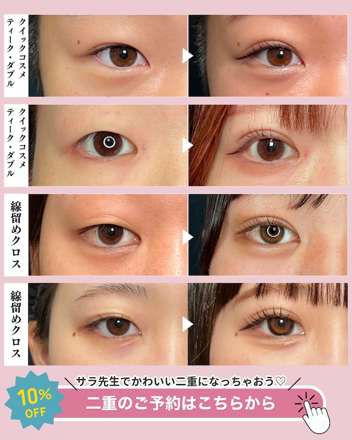 二重の症例写真