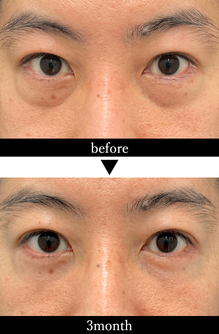凹みと膨らみを同時に改善！【切開ハムラ法】