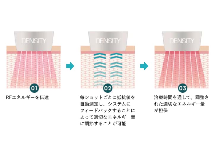 ポイント2　肌の状態を都度確認し、均一なエネルギーを照射