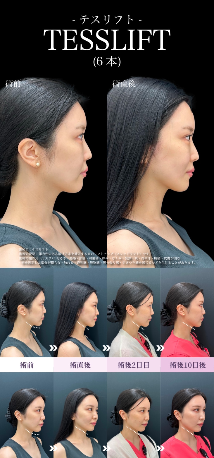 テスリフト症例