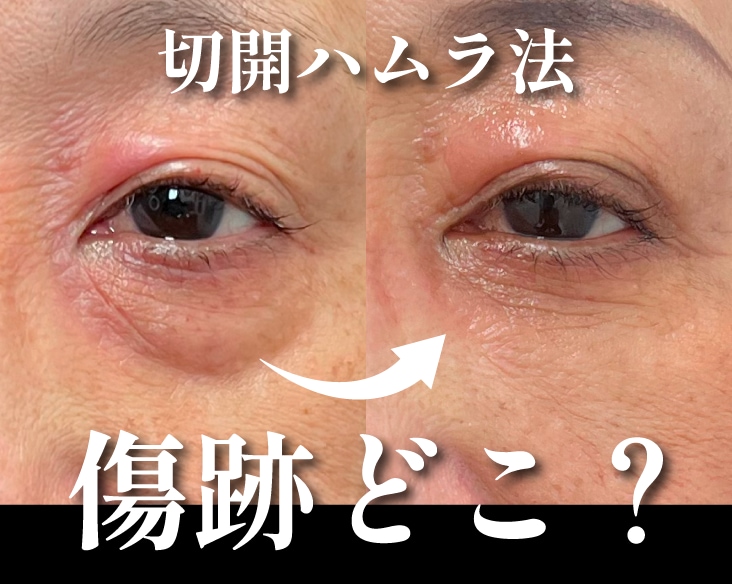 【横浜】切開ハムラ法(クマ取り)の傷跡は綺麗になるの？