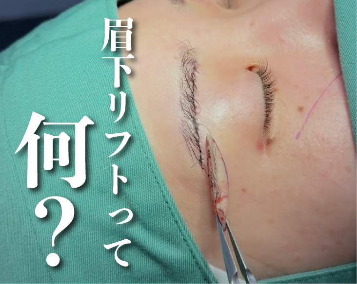 横浜で眉下リフト（眉下切開）するならSBC新横浜院！【若返り】
