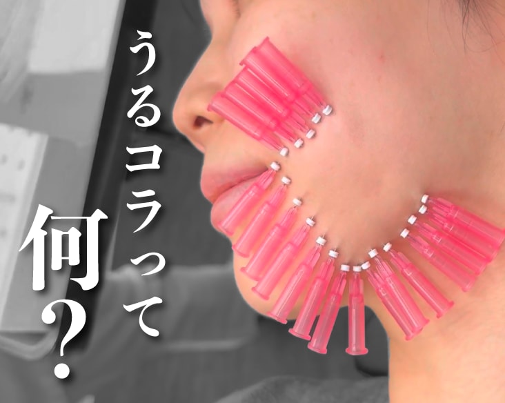 【横浜】切らないたるみ治療|うるおいコラーゲンリフト（ショッピングリフト）
