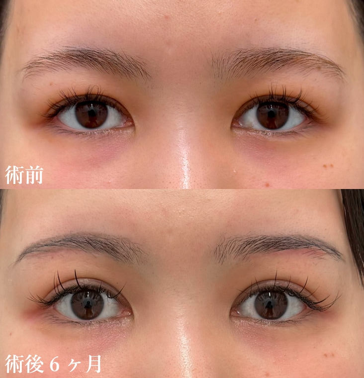 術前→術後6ヶ月