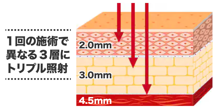 新横浜院のトリプル照射。2.0mm・3.0mm・4.5mmの3層に照射