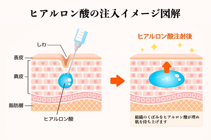 ヒアルロン酸製剤とは？もともと体内にある成分に近い構造