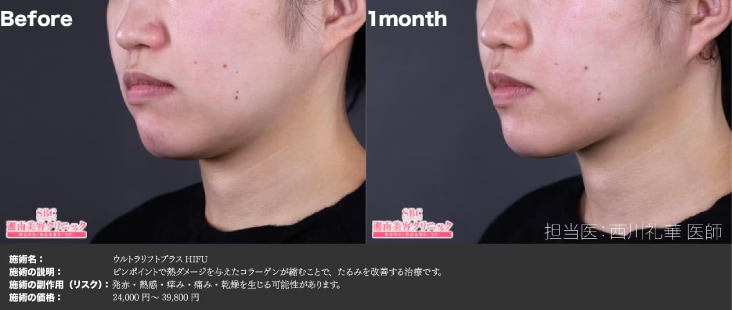 フェイスラインのぼやけ・ほうれい線・二重あごが目立ち始めたら