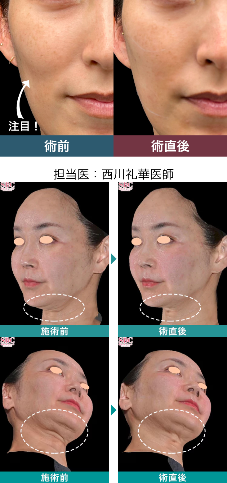 頬のもたつき・ほうれい線・二重あごが気になり始めた方へ