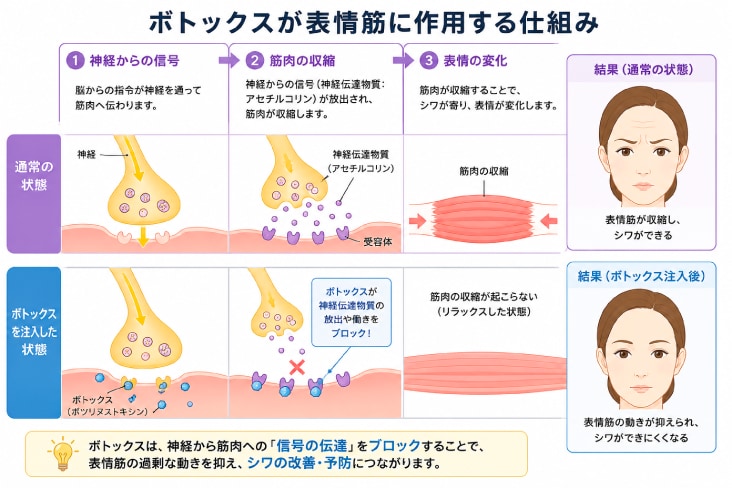 表情筋の動きを一時的に抑えて、シワの原因をブロックする仕組み