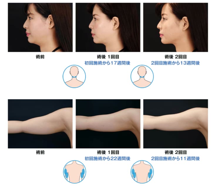 脂肪冷却は回数を重ねるごとにさらに効果UP!