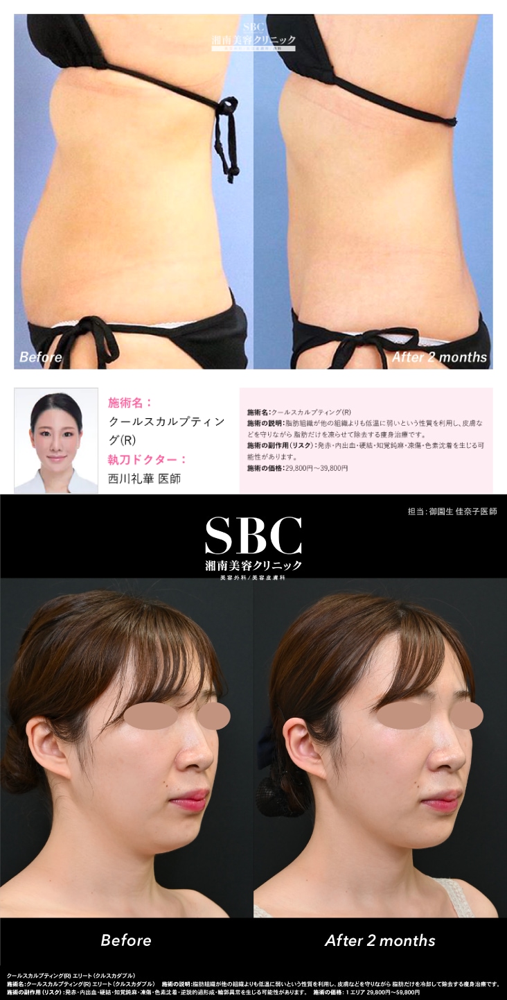 横浜エリア】リバウンドなしの痩身治療ならクールスカルプティング