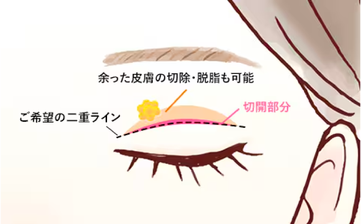 皮膚を切開して強固な二重ラインを作り上げる二重整形