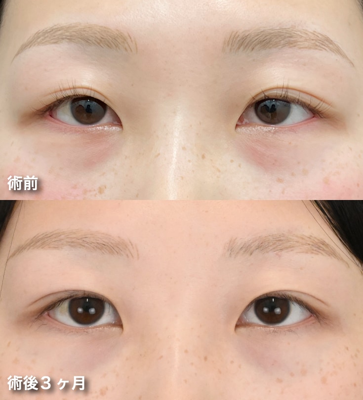 全切開法二重術