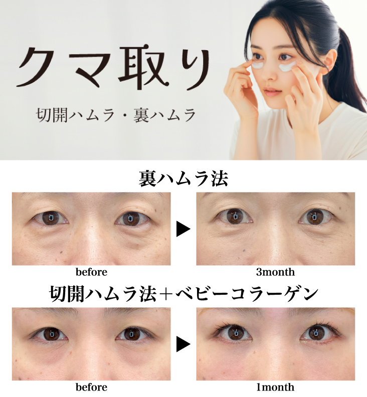 クマ取り